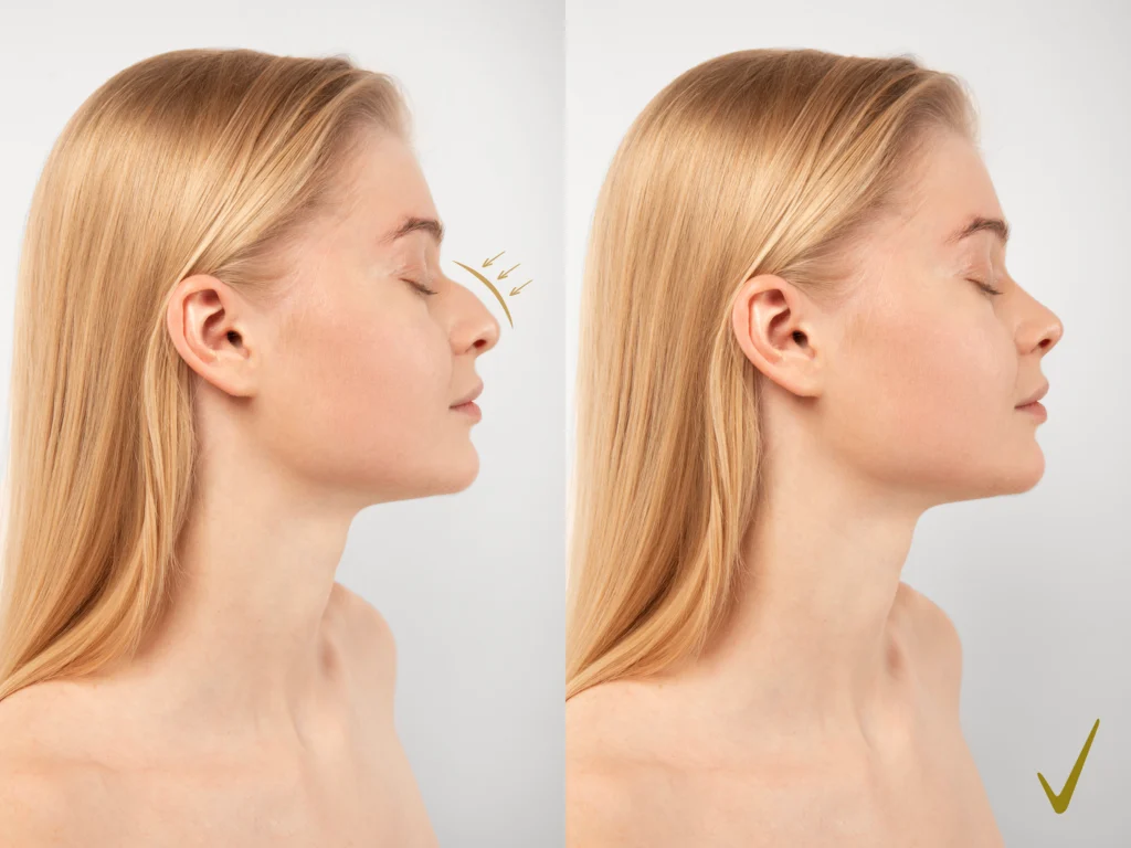 Before and after a nose job surgery.