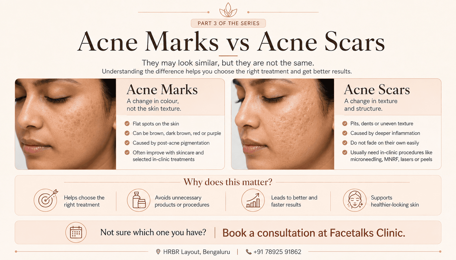 Acne marks vs acne scars comparison showing pigmentation, pits and uneven skin texture at Facetalks Clinic Bangalore.