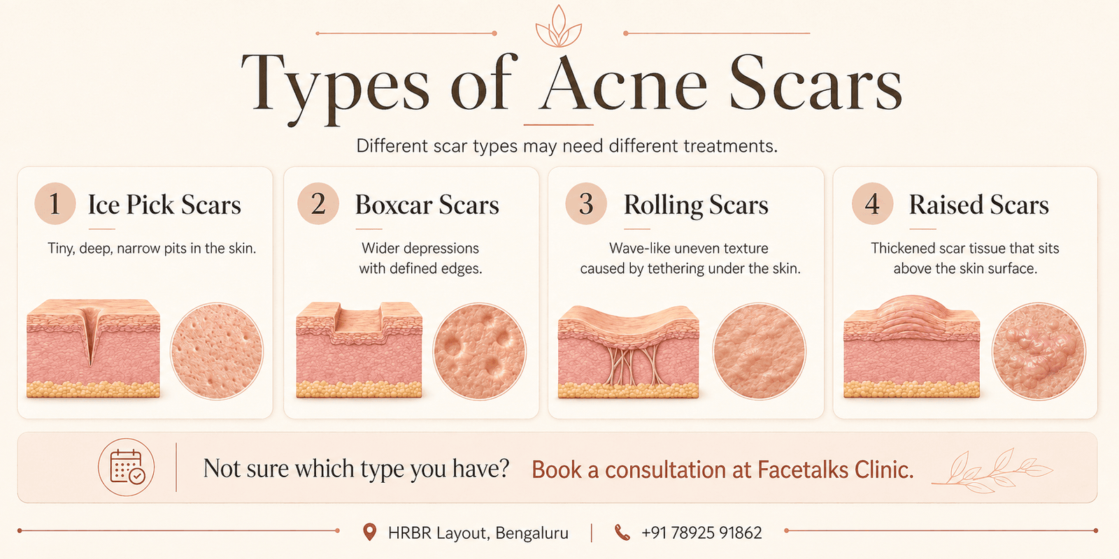 Acne scar treatment options including microneedling, MNRF, PRP, chemical peels and laser treatment at Facetalks Clinic Bangalore.