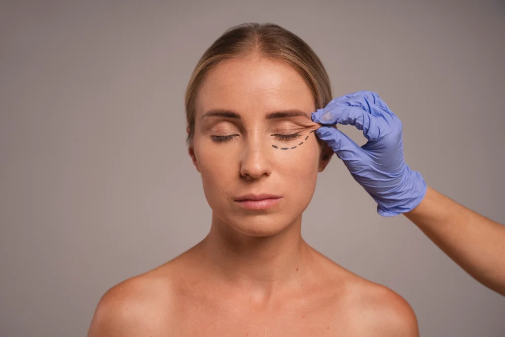 A woman preparing for Blepharoplasty.