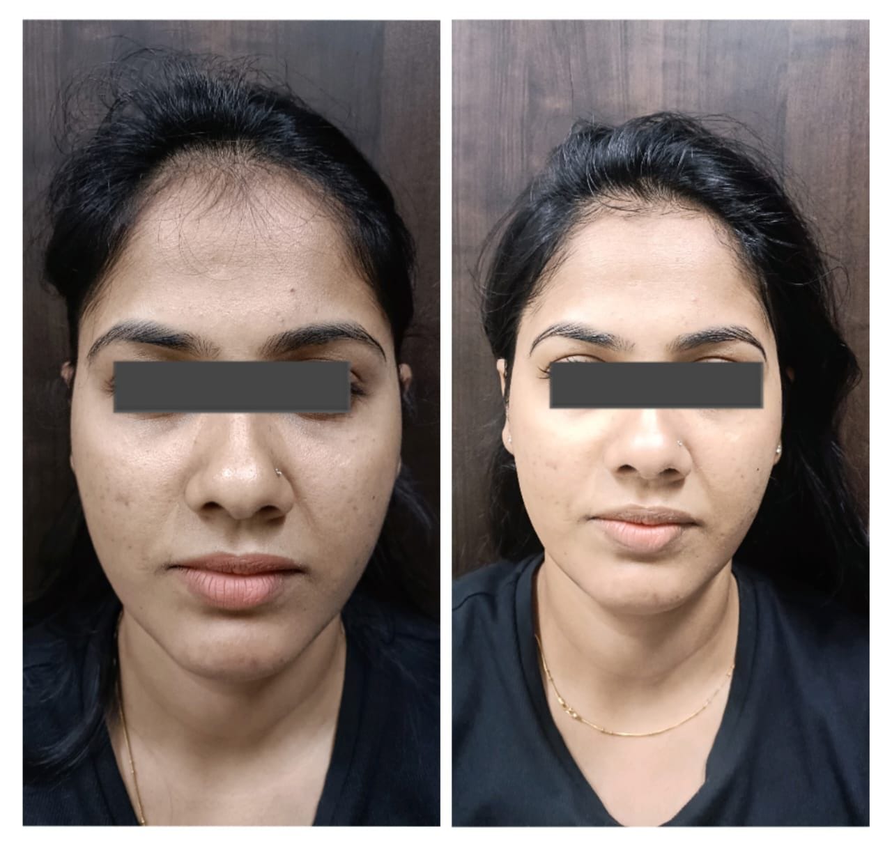 botox, fillers, PRP treatment, GFC treatment