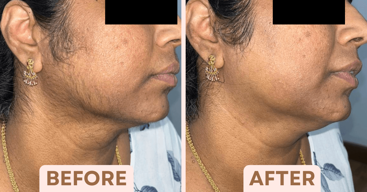 Before and after female facial laser hair removal treatment reducing jawline and chin hair at Facetalks Clinic Bangalore
