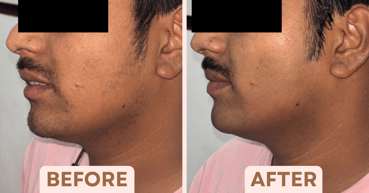 Before and after male beard line laser hair removal treatment at Facetalks Clinic Bangalore