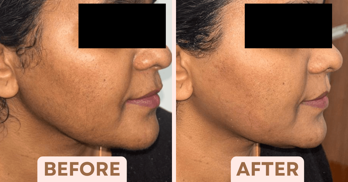 Before and after facial laser hair reduction results for Indian skin at Facetalks Clinic Bangalore