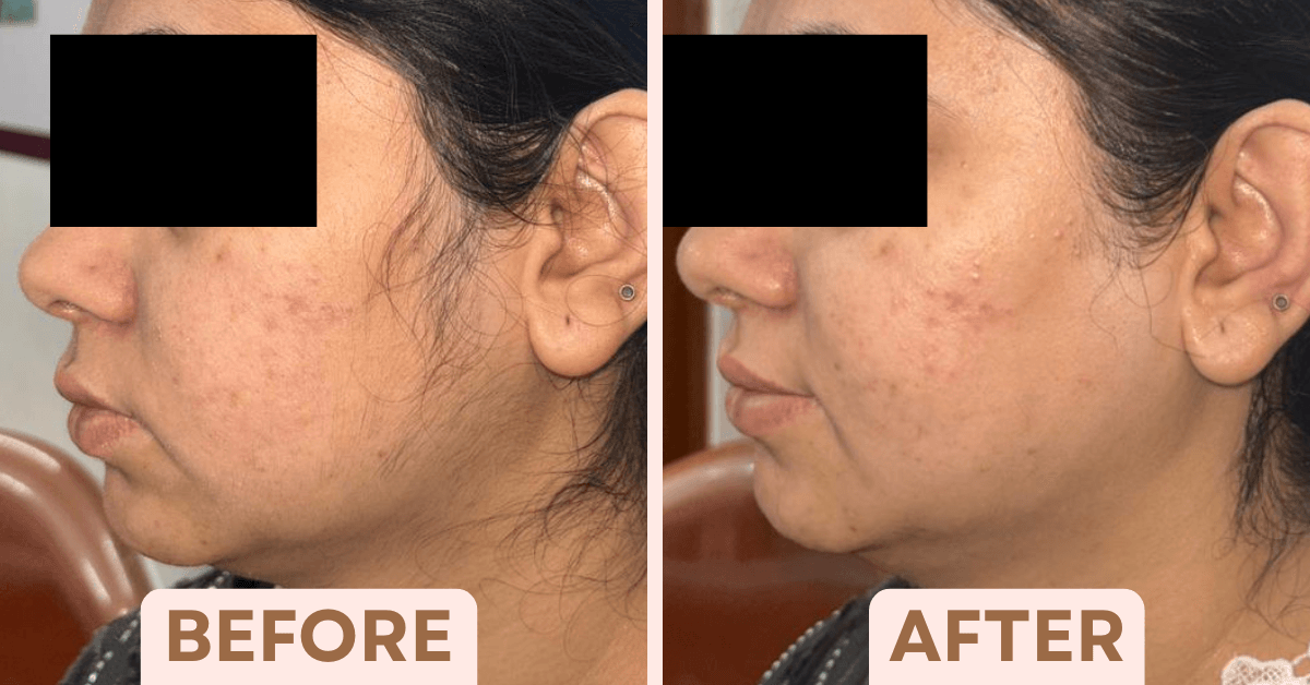 Before and after laser hair removal treatment reducing facial hair growth and improving skin texture