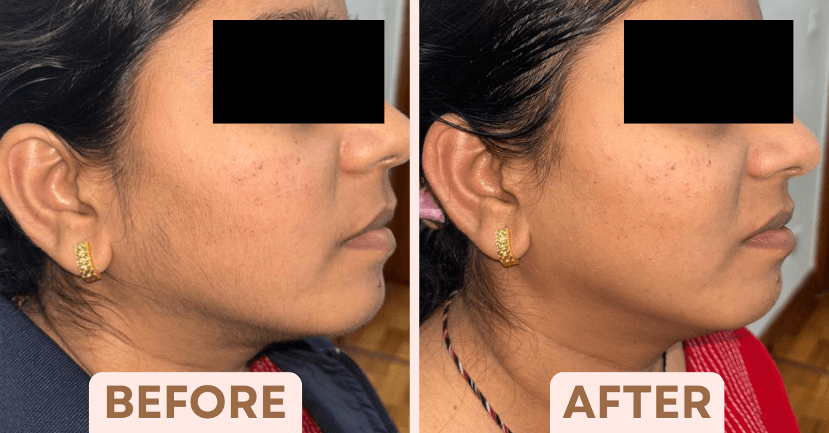 Before and after sideburn and jawline laser hair removal results for women at Facetalks Clinic Bangalore
