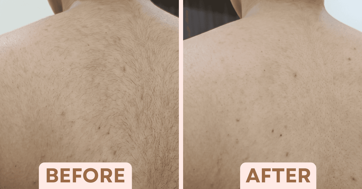 Before and after back laser hair removal treatment showing reduced hair growth at Facetalks Clinic Bangalore