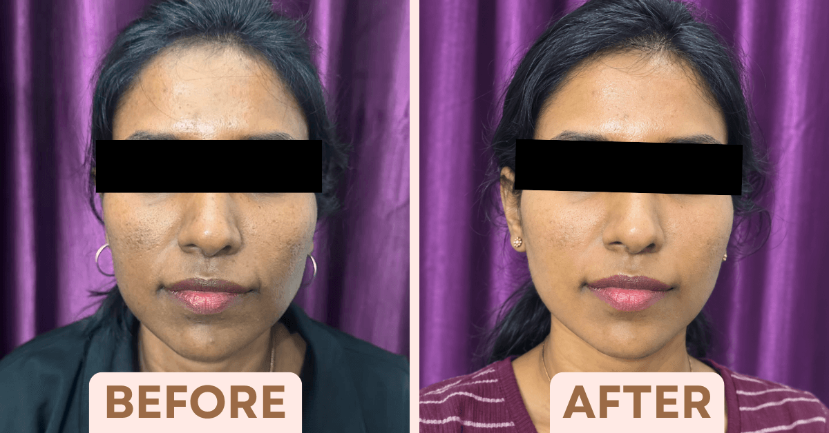 Before and after chemical peel treatment showing reduced acne marks and smoother, more even skin texture at Facetalks Clinic Bangalore.