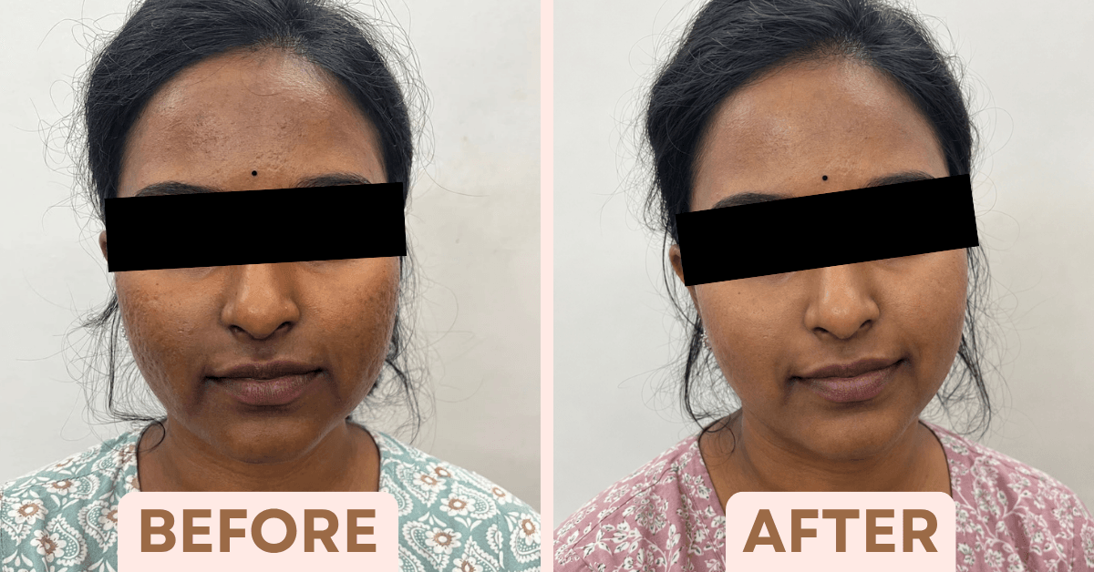 Before and after chemical peel results showing calmer, more even-toned skin with visibly reduced redness.