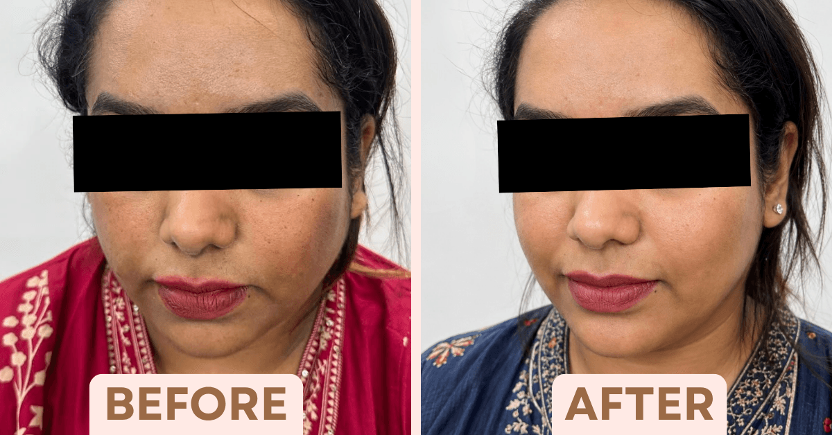 Before and after chemical peel treatment for men showing refined skin texture and fewer visible acne marks.