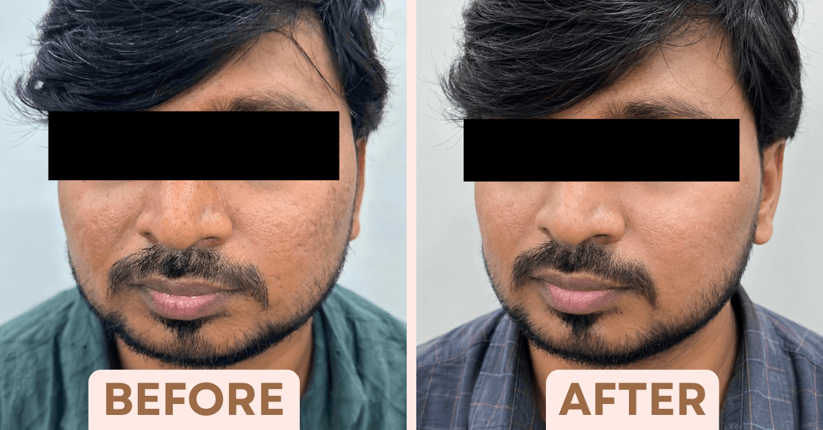 Before and after chemical peel results showing brighter, smoother skin at Facetalks Clinic HRBR Layout.