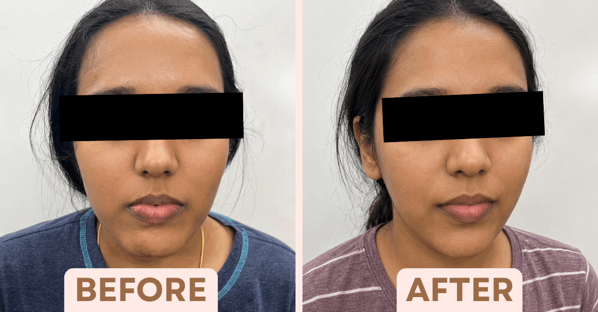 Before and after chemical peel treatment showing visibly reduced acne breakouts and clearer skin.