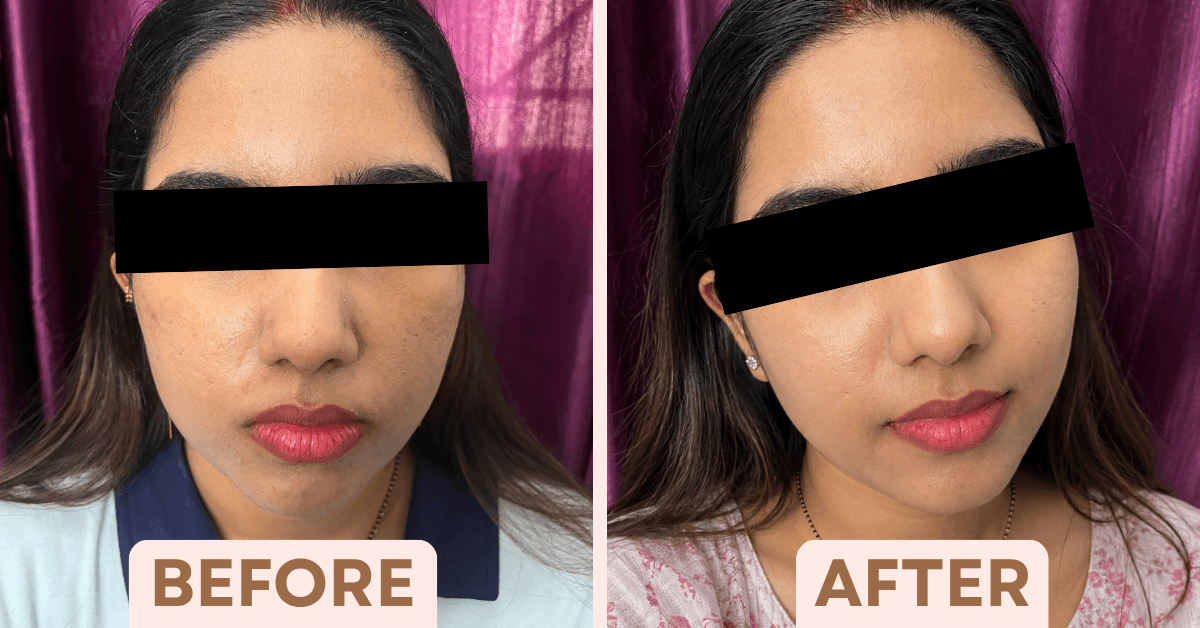 Before and after chemical peel results showing faded post-acne dark marks and more even skin tone.