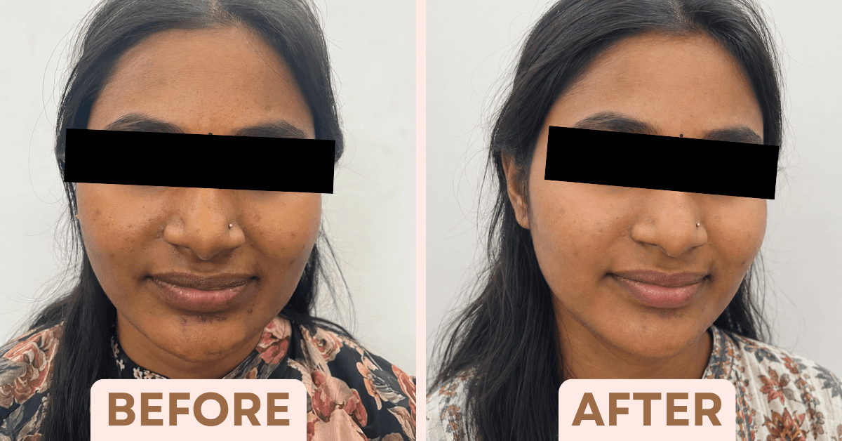 Before and after chemical peel treatment showing significantly reduced facial pigmentation and even skin tone in a Bangalore patient.