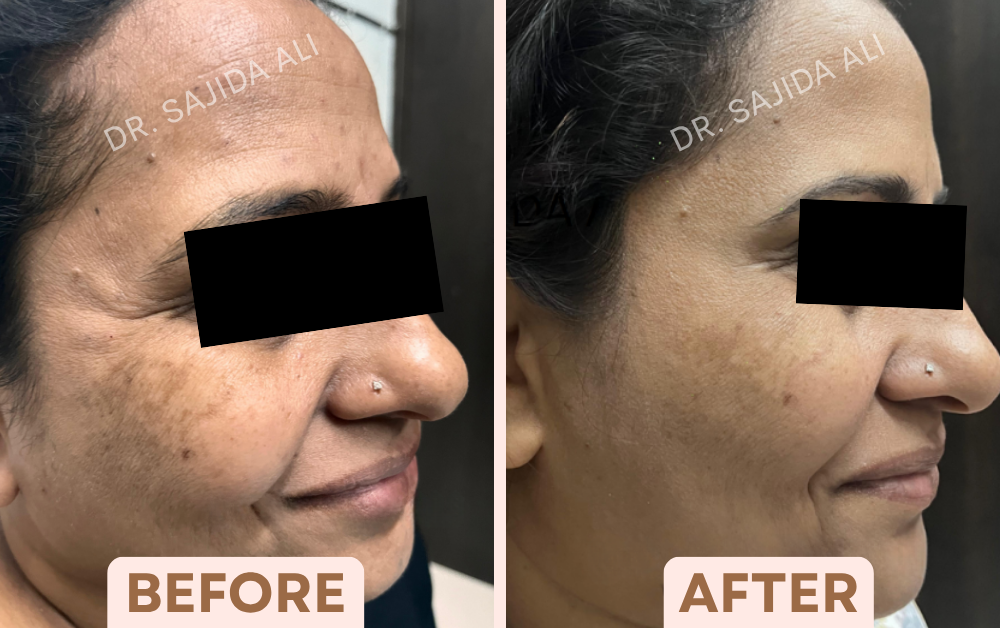 Before and after crow's feet Botox, side profile, showing softer lines at the outer corner of the eye, treated by Dr. Sajida Ali in Bangalore