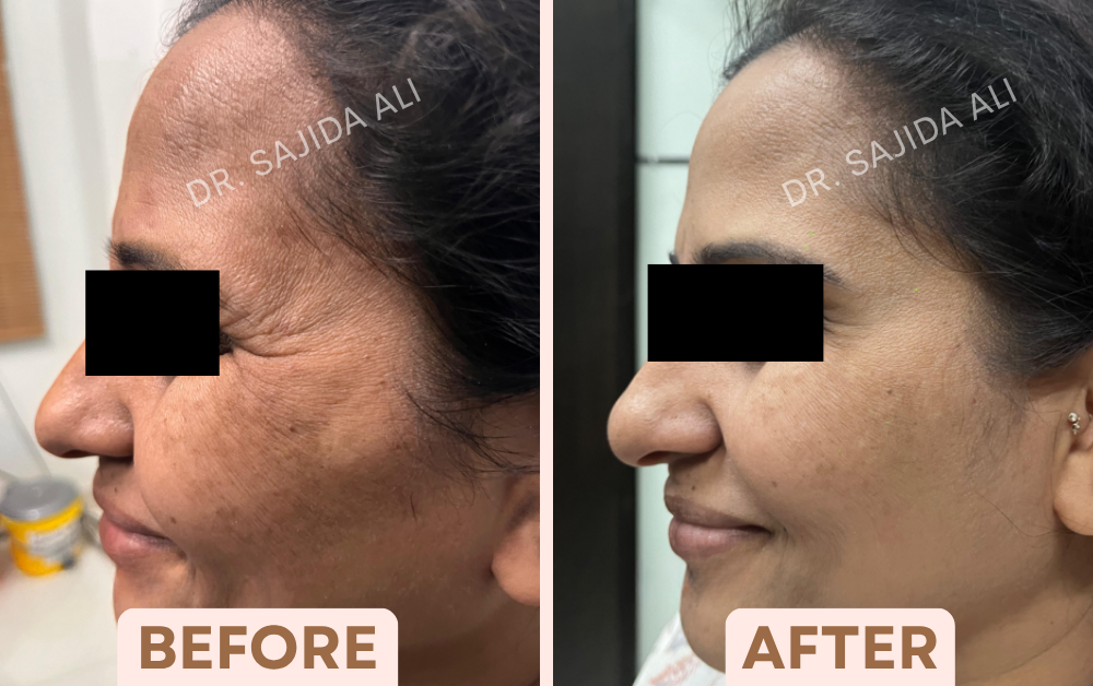 Before and after crow's feet Botox, side profile while smiling, showing fewer lines around the eye, treated by Dr. Sajida Ali in Bangalore