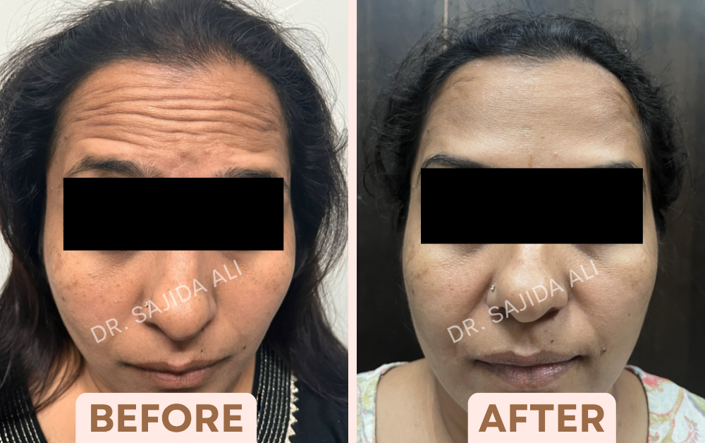 Before and after forehead Botox showing smoother horizontal forehead lines, treated by Dr. Sajida Ali in Bangalore