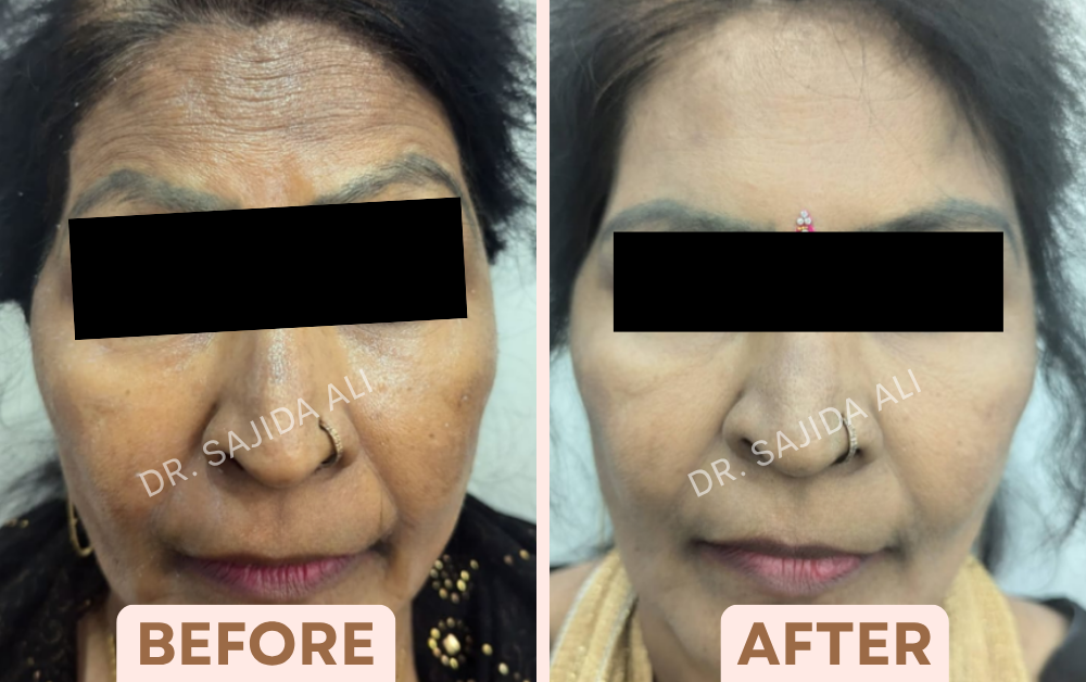 Before and after Botox for deep forehead wrinkles, front view, showing a smoother forehead, treated by Dr. Sajida Ali in Bangalore