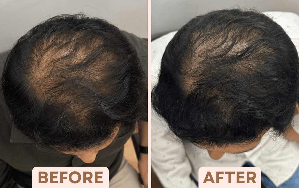 Before and after GFC hair treatment showing hair regrowth at the crown at Facetalks Clinic Bangalore