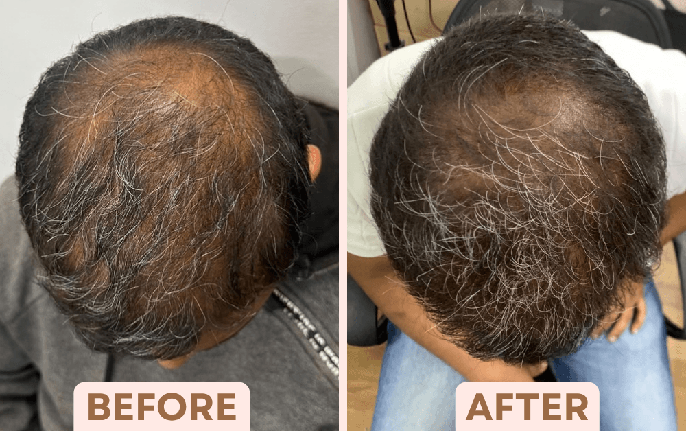 Before and after GFC hair treatment showing improved coverage of crown thinning in greying hair at Facetalks Clinic Bangalore