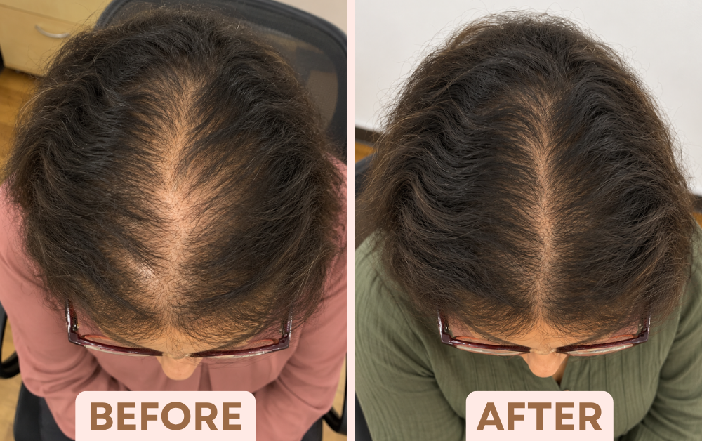 Before and after GFC hair treatment showing a narrower, fuller hair parting in a woman with hair thinning at Facetalks Clinic Bangalore