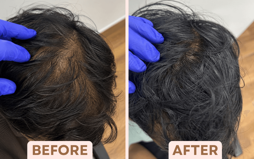 Before and after GFC hair treatment showing improved hair density along the parting at Facetalks Clinic Bangalore