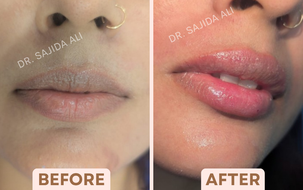 Before and after lip fillers showing fuller upper and lower lips, treated by Dr. Sajida Ali in Bangalore