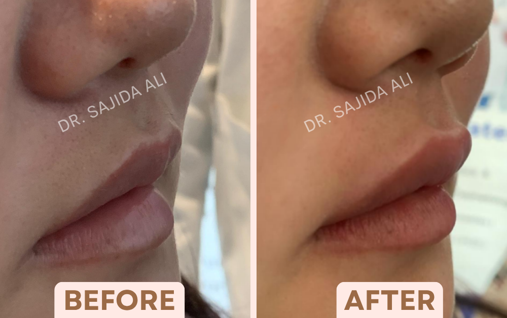 Before and after lip fillers, side profile, showing fuller, more defined lips, treated by Dr. Sajida Ali in Bangalore