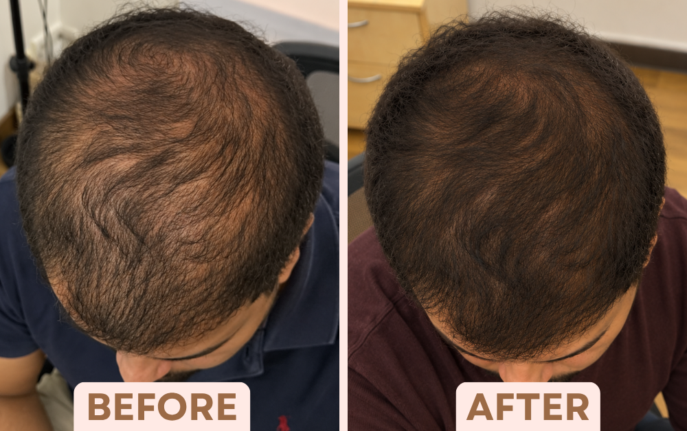 Before and after PRP hair treatment showing improved coverage of crown thinning at Facetalks Clinic Bangalore