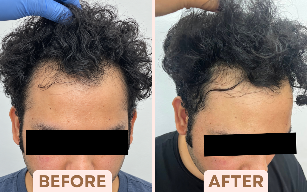 Before and after PRP hair treatment showing improved hair along a receding hairline at Facetalks Clinic Bangalore