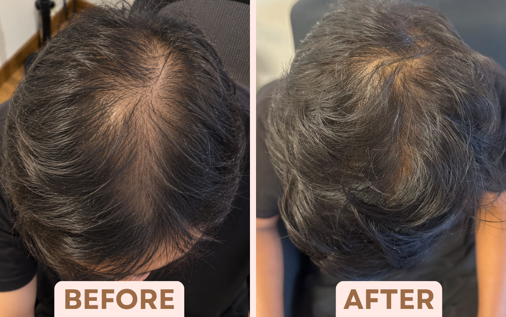 Before and after PRP hair treatment showing fuller hair on the top of the head in greying hair at Facetalks Clinic Bangalore