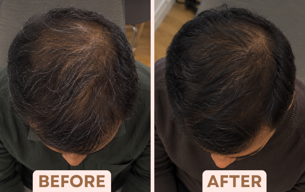 Before and after PRP hair treatment showing thicker hair on the top of the head at Facetalks Clinic Bangalore