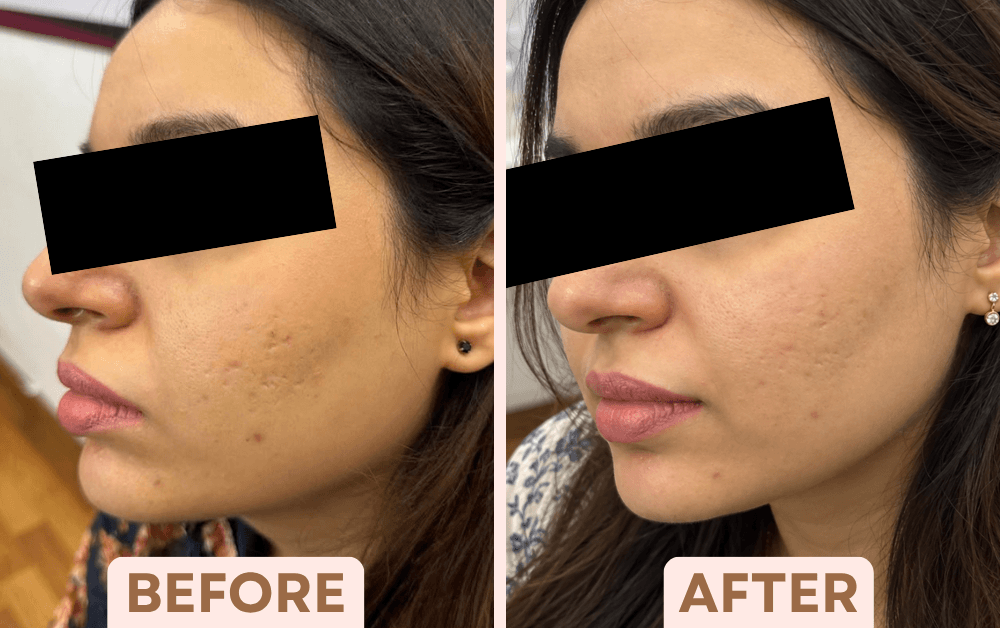 Before and after Vampire Facial treatment showing smoother, less pitted acne scarring at Facetalks Clinic Bangalore