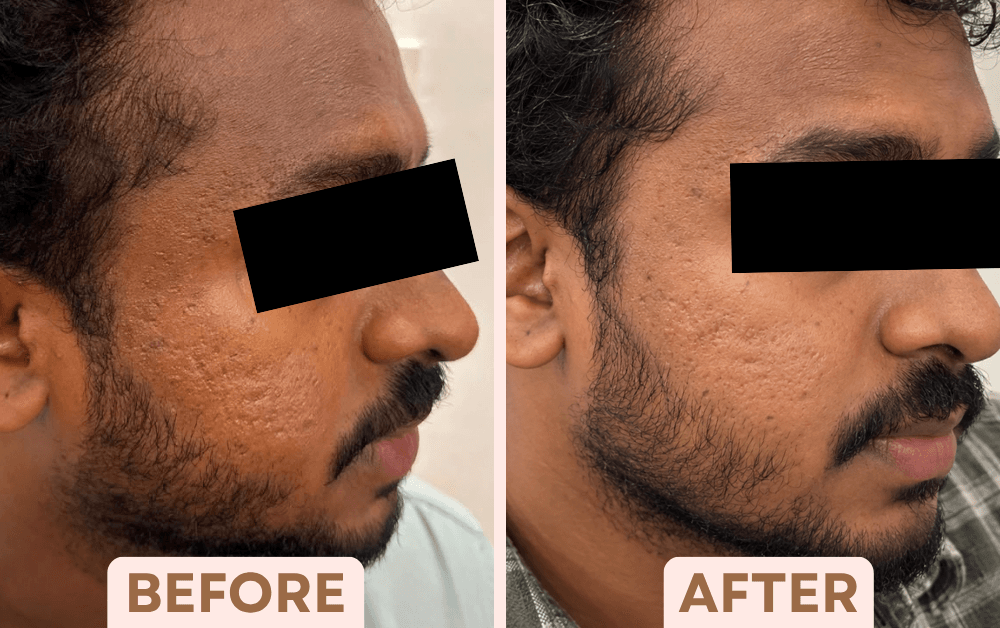 Before and after Vampire Facial treatment showing softened acne scarring on a man's cheek at Facetalks Clinic Bangalore