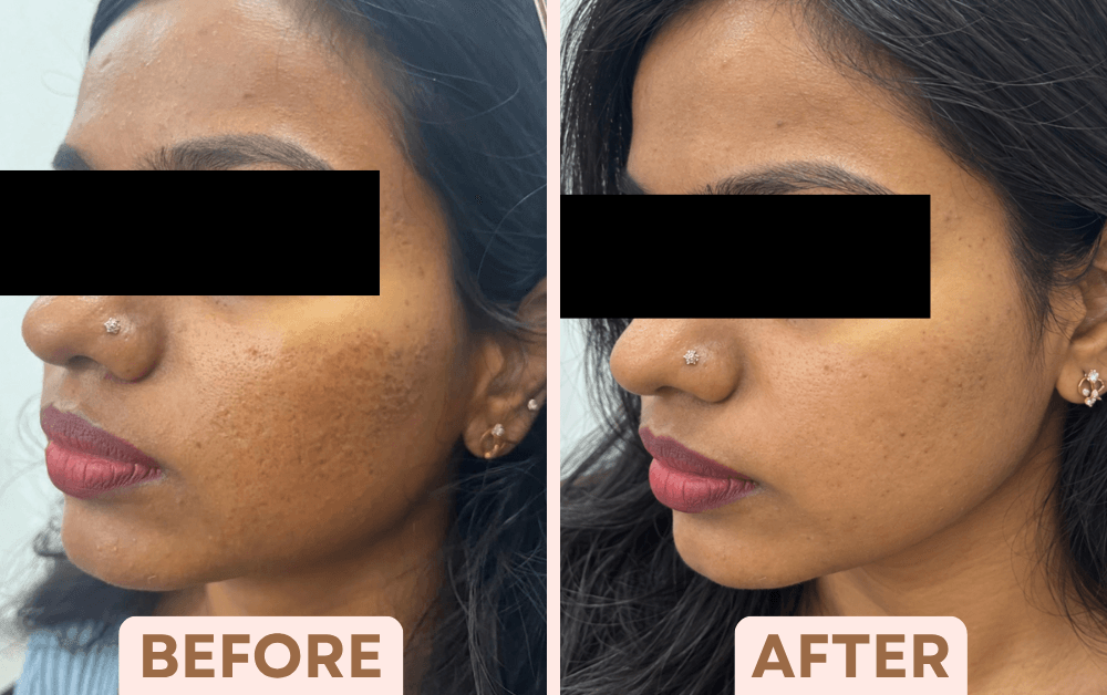 Before and after Vampire Facial treatment showing reduced pigmentation and more even skin tone at Facetalks Clinic Bangalore