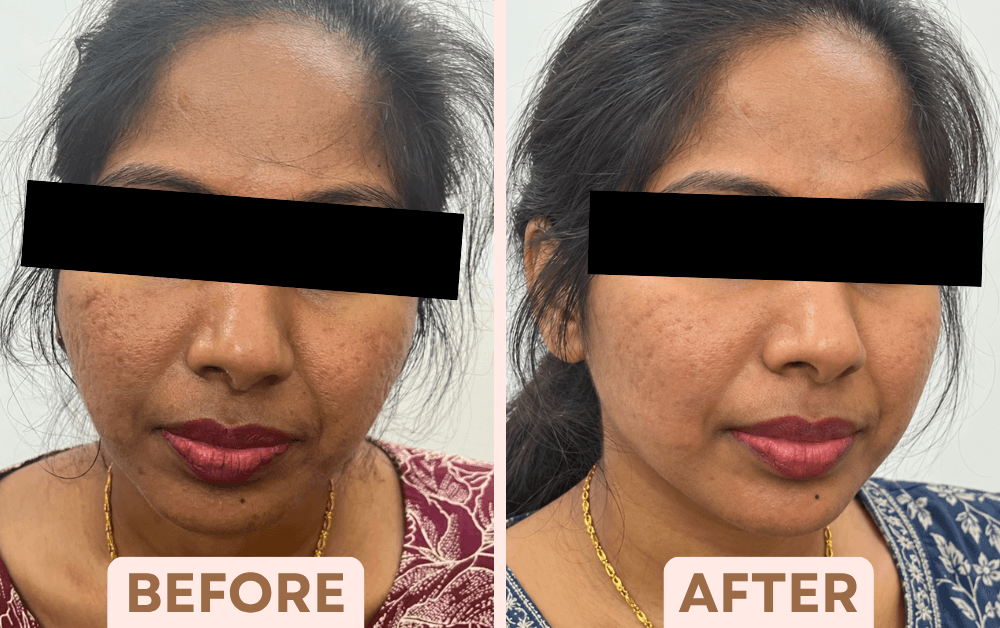 Before and after Vampire Facial treatment showing improved skin texture and glow at Facetalks Clinic Bangalore