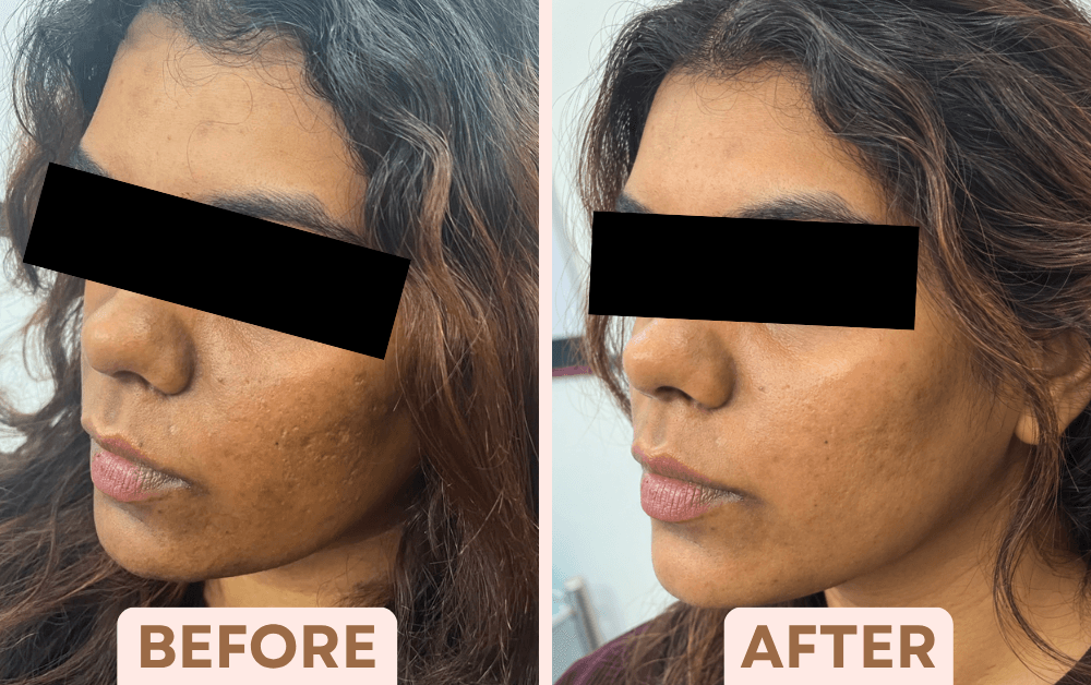 Before and after Vampire Facial treatment showing smoother, more even cheek texture and tone at Facetalks Clinic Bangalore